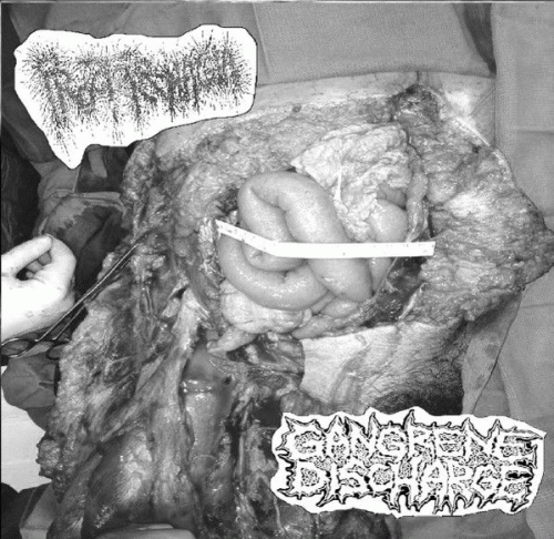 Gangrene Discharge : Gangrene Discharge - Proctorrhagia